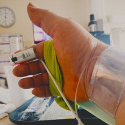 Novant Health Huntersville Medical Center - Blood oxygen sensor thing and one of several tubes stuck into my arm...