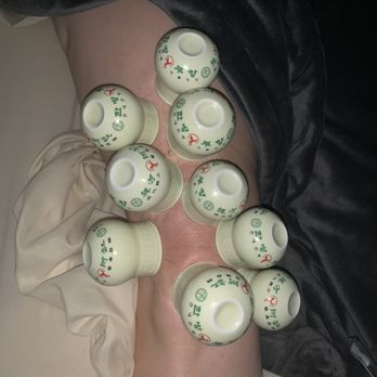 Breathe Total Balance - Cupping therapy for Knee Pain - Acupuncture Near Me - Long Beach, California Breathe Total Balance - Cupping therapy for Knee Pain - Acupuncture Near Me - Long Beach, California