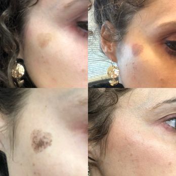 Lumera Skin & Laser - BBL Moxi results. My sun spot is gone! - Medical Spas Near Me - Phoenix, Arizona