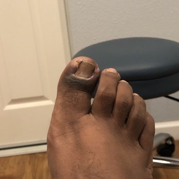 Payman Hoshyarsar, DPM - After my nail was removed about two weeks after - Podiatrists Near Me - El Monte, California Payman Hoshyarsar, DPM - After my nail was removed about two weeks after - Podiatrists Near Me - El Monte, California