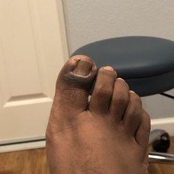 Payman Hoshyarsar, DPM - After my nail was removed about two weeks after