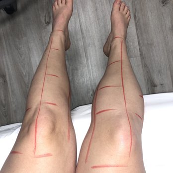 Clearstone - The Mapping of my legs. Pretty neat!! - Laser Hair Removal Near Me - League City, Texas
