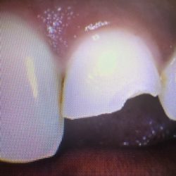 Hilltop Family Dental - My poor tooth :(
