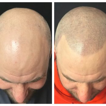 Boho Cosmetic Tattoo - Before & After Scalp Micropigmentation - Permanent Makeup Near Me - Eugene, Oregon