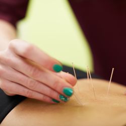 Sitka Physio & Wellness - Acupuncture can provide instantaneous pain relief. It works well within an integrated physiotherapy treatment program.