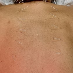 Saban Community Clinic - Beverly - Outstanding acupuncture