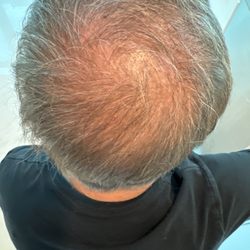 Bosley Hair Restoration & Transplant - My scalp is still showing.