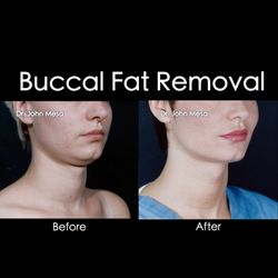 John Mesa MD PLLC PC New Jersey - Buccal Fat Removal & Chin Liposuction