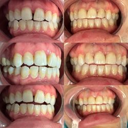 JK Family Dental - Closing the gap naturally . Smile makeover in just 30minutes!!