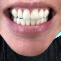 Teeth whitening! Teeth whitening!