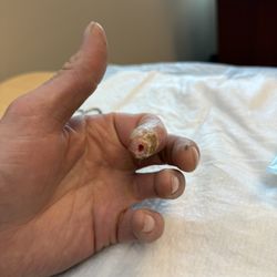 Colorado Springs Orthopaedic Group - Dr. Cassidy said let see if scar tissue will creates fibers which fibers to heal the bone. It hasn't in two months why would it now.