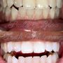 Smile and Glow Teeth Whitening