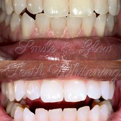 Smile and Glow Teeth Whitening - 60 minutes standard session