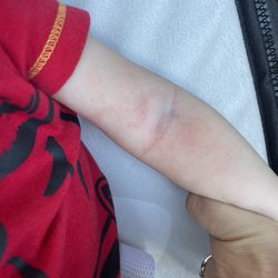 Labcorp - Moretones en el brazo de mi bebé por apretarle muy fuerte para sacar sangre.