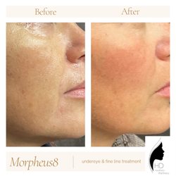 HD Aesthetic Wellness - Morpheus8 under eyes
