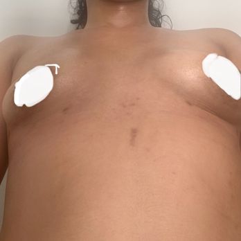 Sean A Simon, MD - uneven result - Cosmetic Surgeons Near Me - Miami, Florida
