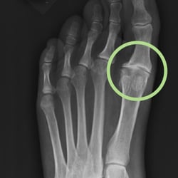 Orange County Podiatry - Great Toe Arthritis - NB