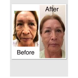 Kian Wellness - Fibroblast skin tightening treatment by Dr Kian Masoumi