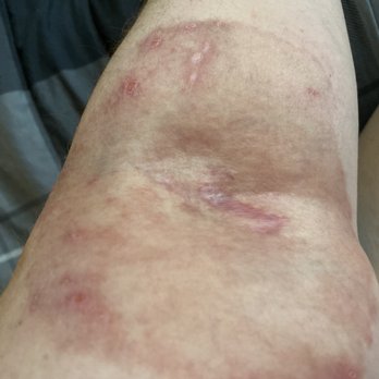 James Weintraub, MD - After 10 days, no more burning, almost no redness, no itching - Dermatologists Near Me - Simi Valley, California James Weintraub, MD - After 10 days, no more burning, almost no redness, no itching - Dermatologists Near Me - Simi Valley, California
