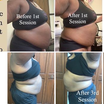 Dream Shape Body Contouring - 1st & 3rd session - Body Contouring Near Me - Norfolk, Virginia