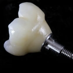 Kiva Dental Arts Lab - BruxZir Solid Zirconia Implant