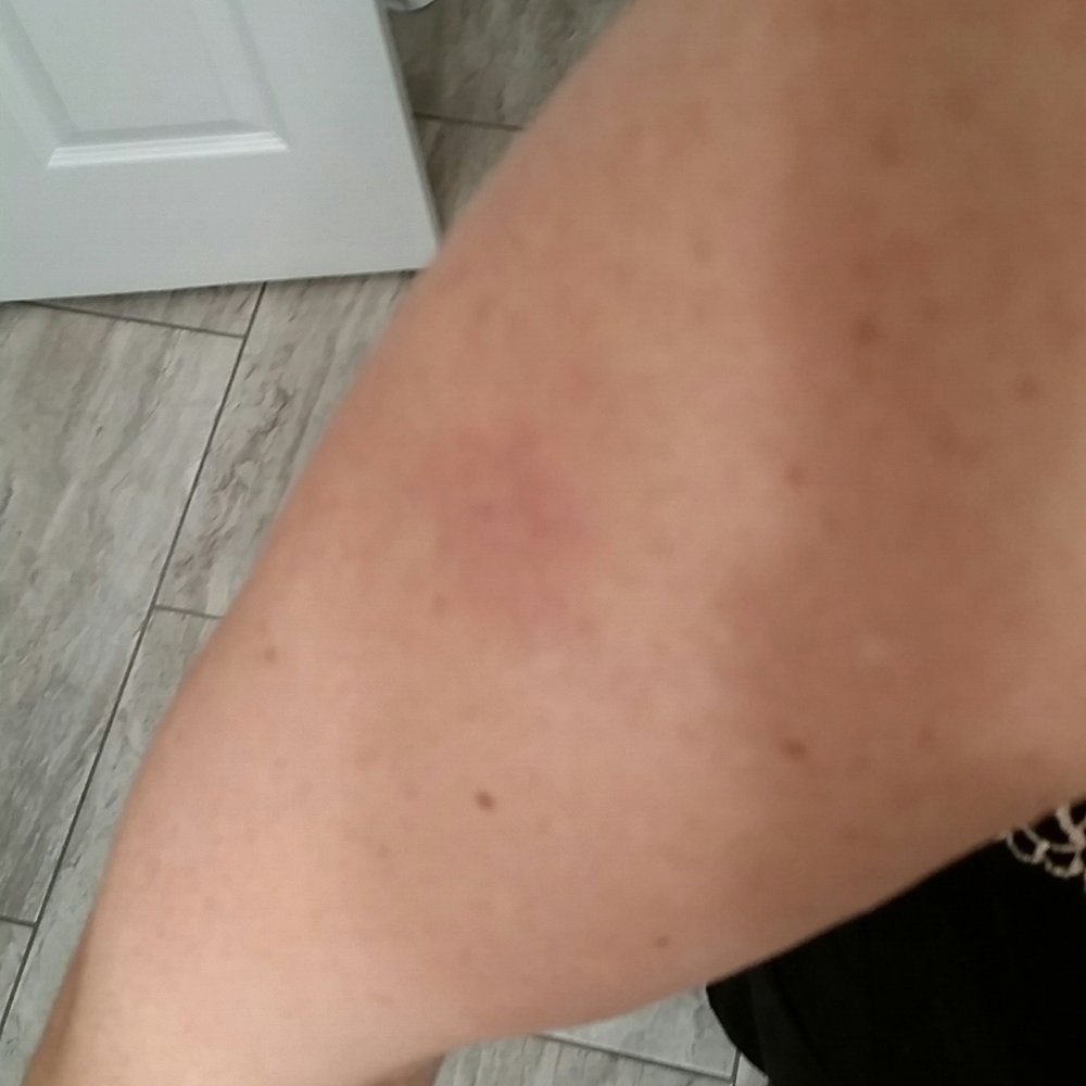 Daily Massage - Bruised from the massage - Massage Near Me - Woodstock, Georgia Daily Massage - Bruised from the massage - Massage Near Me - Woodstock, Georgia