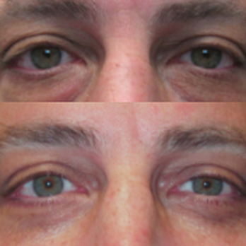 Warren C Stout, MD - Before and After! 48-Year-Old Male Upper & Lower Eyelid Procedures - Cosmetic Surgeons Near Me - Pasadena, California Warren C Stout, MD - Before and After! 48-Year-Old Male Upper & Lower Eyelid Procedures - Cosmetic Surgeons Near Me - Pasadena, California