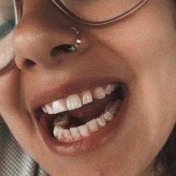 Woodbridge Smiles - The teeth Dr Kim said needed to be fully reconstructed.
