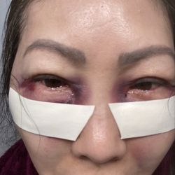Wenjing Liu, MD - Immediately after surgery. I am an extreme bruiser and sweller but it didn't hurt at all.