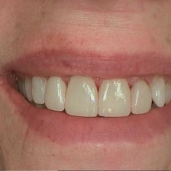 Daniel C Garcia, DDS - After fixing her Chipped and Fractured Teeth with Veneers! Wow! This patient was in tears with joy after our repair!