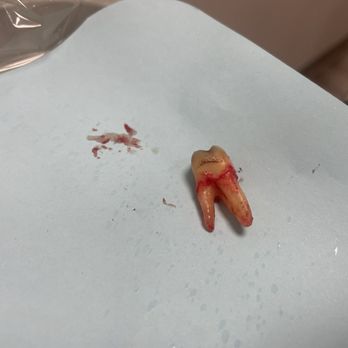 A Plus Dental Group - Tooth Extracted - Pediatric Dentists Near Me - Las Vegas, Nevada