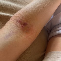 BioLife Plasma Services - The day after donating