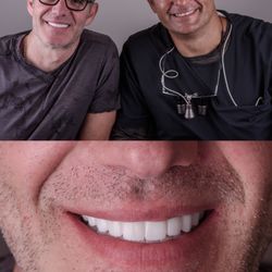 All-on-4 maintenance appointment with AirFLowONE EMS. Double arch case cruising for 4 years with smile and confidence.