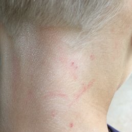 Skin damage after haircut. The skin already disinfected by antiseptic napkins. Skin damage after haircut. The skin already disinfected by antiseptic napkins.