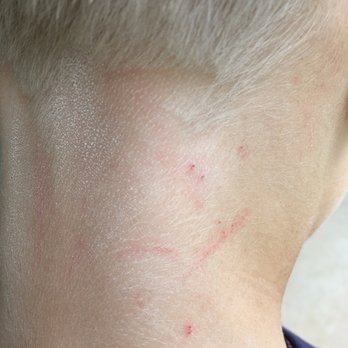 Snipedy DO Dahs Kid Salon - Skin damage after haircut. The skin already disinfected by antiseptic napkins. - Hair Salons Near Me - Boca Raton, Florida Snipedy DO Dahs Kid Salon - Skin damage after haircut. The skin already disinfected by antiseptic napkins. - Hair Salons Near Me - Boca Raton, Florida