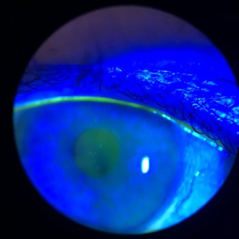InterMountain Eye Associates, P.C. - Corneal disease and dry eye are areas of expertise for Dr. Vale and his staff at InterMountain Eye. - Ophthalmologists Near Me - Scranton, Pennsylvania InterMountain Eye Associates, P.C. - Corneal disease and dry eye are areas of expertise for Dr. Vale and his staff at InterMountain Eye. - Ophthalmologists Near Me - Scranton, Pennsylvania