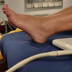 Part 2 after Electrons Plus treatment. Inflammation gone and restored blood circulation