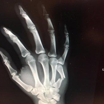 New Jersey Imaging Network of Randolph - My broken 5th metatarsal!!! Thank you Njin - Diagnostic Imaging Near Me - Randolph, New Jersey New Jersey Imaging Network of Randolph - My broken 5th metatarsal!!! Thank you Njin - Diagnostic Imaging Near Me - Randolph, New Jersey