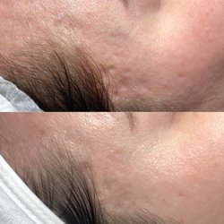Jillian L Skin - Microneedling progress