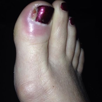 MB Nails & Spa - Toe infection from MB Nails!! - Nail Salons Near Me - Manhattan Beach, California MB Nails & Spa - Toe infection from MB Nails!! - Nail Salons Near Me - Manhattan Beach, California