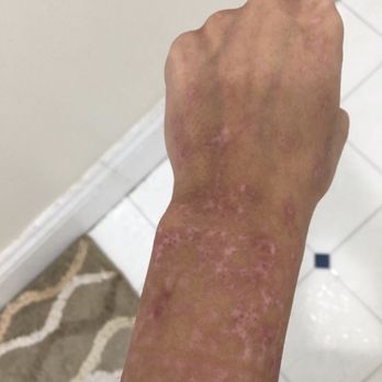Sahiba Salon - Scarring from henna done here 4 weeks ago. - Hair Salons Near Me - Brooklyn, New York
