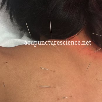 Lei Acupuncture & Herb - Cervical Spondylosis - Acupuncture Near Me - San Jose, California Lei Acupuncture & Herb - Cervical Spondylosis - Acupuncture Near Me - San Jose, California