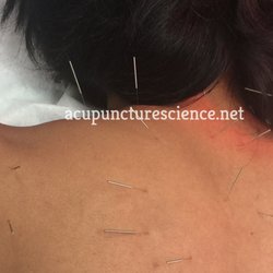 Cervical Spondylosis
