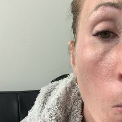 Aspen Dermatology - Under eye filler for dark circles