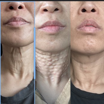 Jeune MedSpa - Including rejuran healer treatment before and after (right photo is 4 days after) - Medical Spas Near Me - La Habra, California