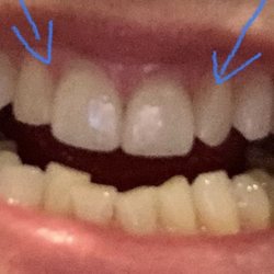 Hughes Orthodontics - Before