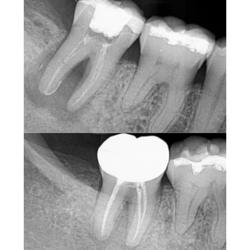 Icon Dental - Infected tooth completely healed with root canal treatment