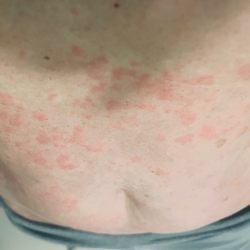 West Marion Community Hospital - Hives! 3600.00 bill for steriods and benedyl! Stay away