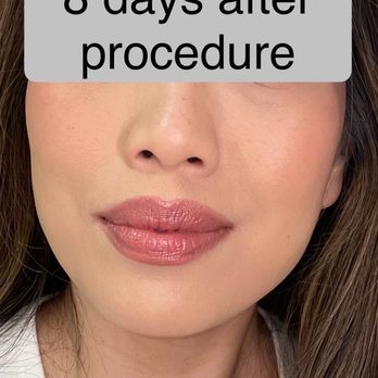 NoBe Wellness Medspa - After Skinvive. No touchup or filter. - Medical Spas Near Me - Las Vegas, Nevada