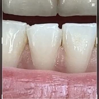 Konikoff Dental Associates Edinburgh - after - General Dentistry Near Me - Chesapeake, Virginia Konikoff Dental Associates Edinburgh - after - General Dentistry Near Me - Chesapeake, Virginia